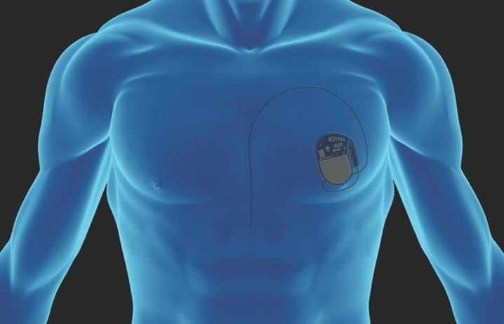 Implantable Cardioverter Defibrillators